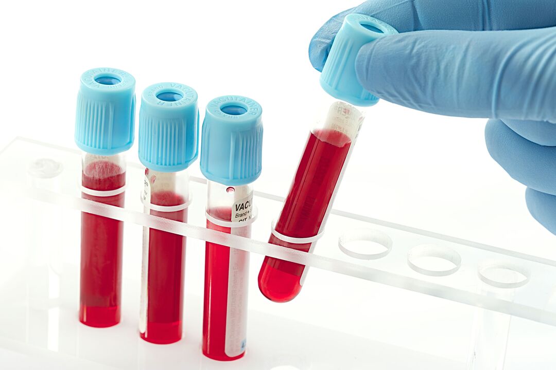 בדיקת דם לאבחון וירוס הפפילומה האנושי