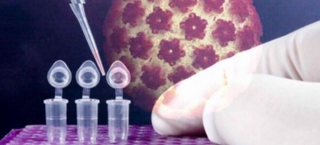 אבחון HPV באמצעות בדיקת digene