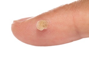 יבלת היא מחלת עור אשר נלחם ביעילות Skincell Pro